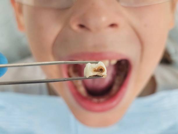 Best Broken or Cracked Tooth Emergency Dentist in Phoenix, OR